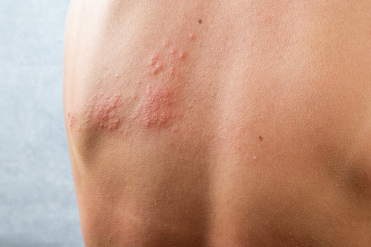Was ist Gürtelrose (Herpes Zoster)?