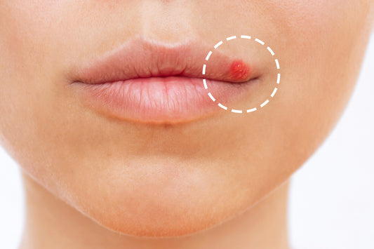 Alles was du über Herpes wissen musst